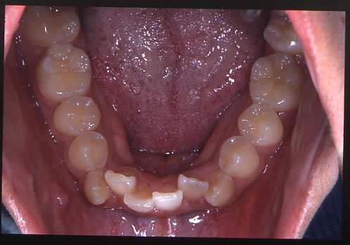 歯列矯正初診時　口腔内　下顎側