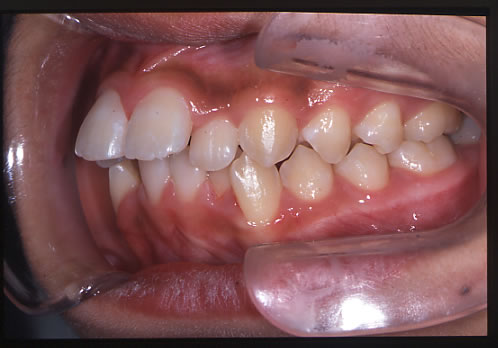 歯列矯正初診時　口腔内　左側