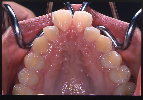 歯列矯正初診時　上顎側
