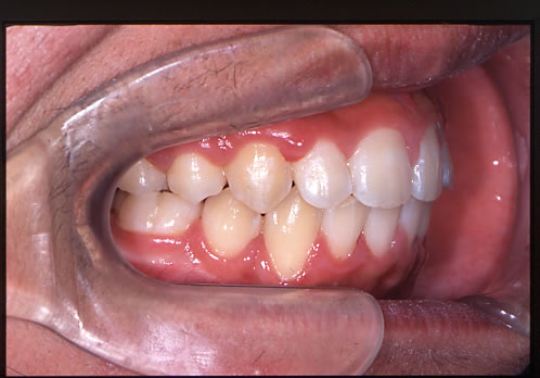 歯列矯正終了時　口腔内　右側