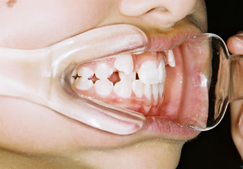 歯列矯正初診時　口腔内　右側