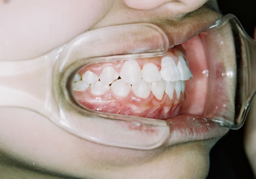 歯列矯正終了時　口腔内　右側