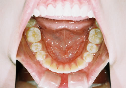 歯列矯正終了時　口腔内　下顎側