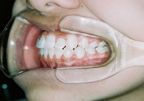歯列矯正終了時　口腔内　左側
